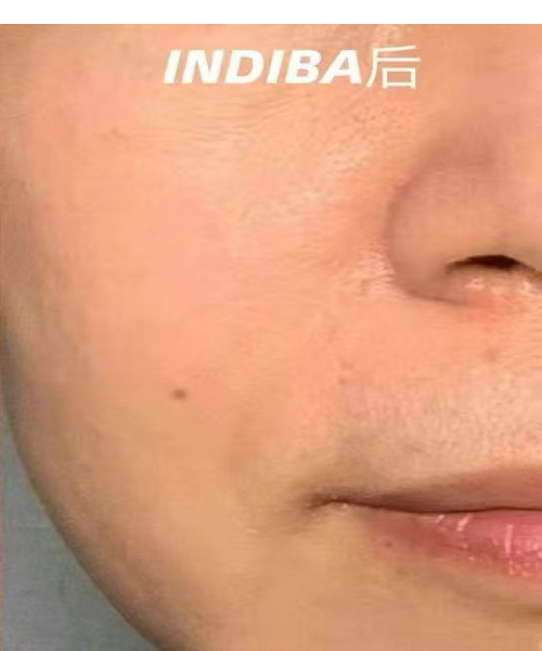 护理后