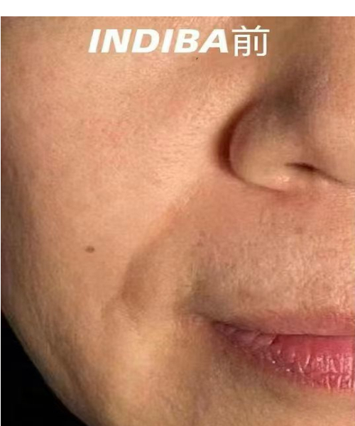 护理前