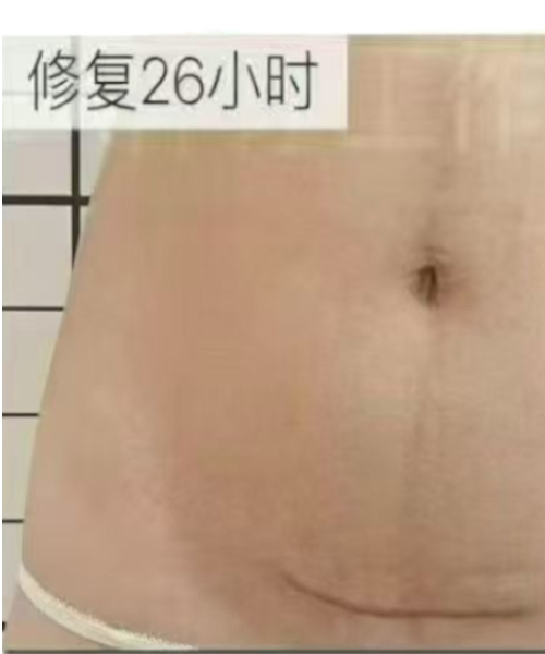 护理后