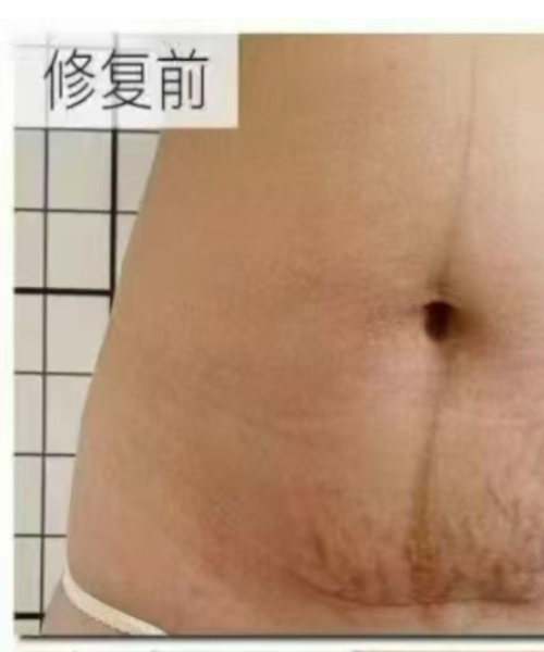 护理前